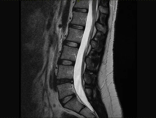An MRI scan showing spinal disc degeneration.