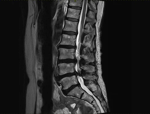 An MRI scan showing narrowing of the spinal canal, known as spinal canal stenosis.