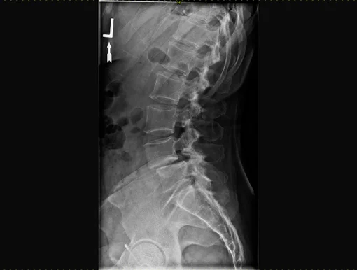 An X-ray side view showing a vertebrae out of alignment, characteristic of spondylolisthesis.