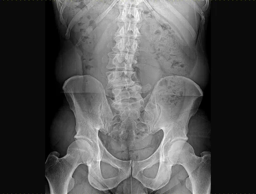 An X-ray image showing the curvature of the spine characteristic of scoliosis.