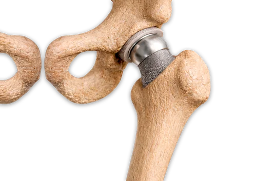 A detailed medical 3D illustration showing an artificial hip joint implant inserted into a human femur and pelvis.